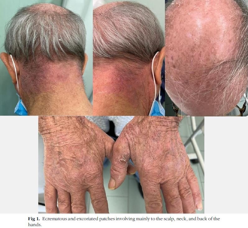 Dermatite atopica su paziente 80enne in studio scientifico