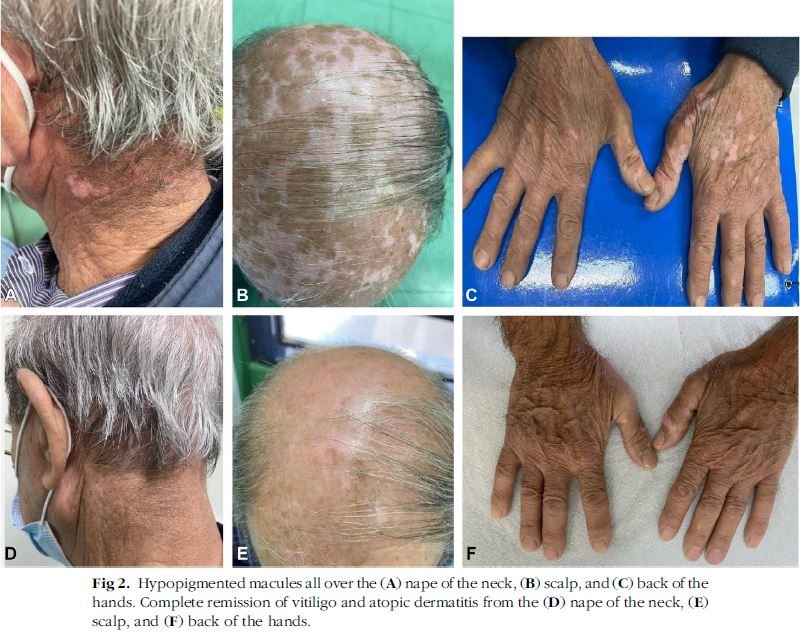 Vitiligine causata da dermatite atopica su paziente 80enne in studio scientifico